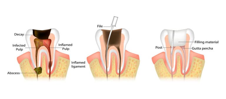 Endodontic Root Canal Treatment Process