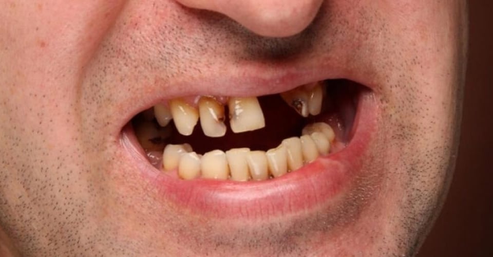 surprisingly-simple-dental-implant