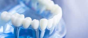 dental-implants-guide