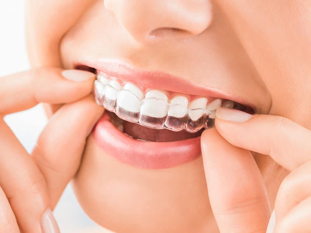 Right Here's What You Require To Find Out About Invisalign Melbourne