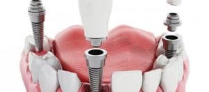 dental-implant-seniors melbourne