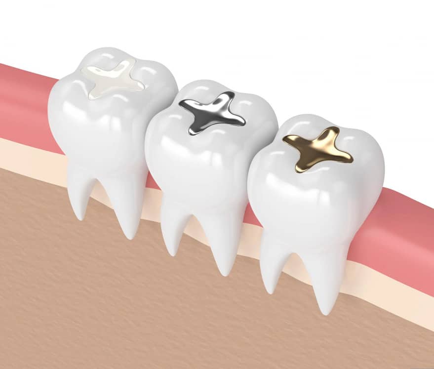 filling-dentistry
