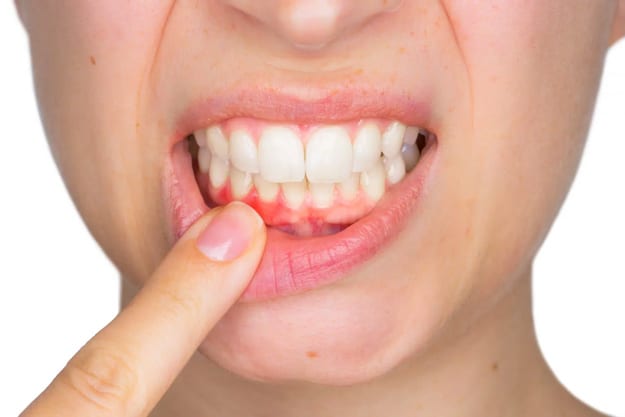 dental-gum-disease-prevention