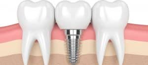 root-canal-vs-dental-implants