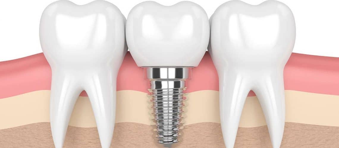 root-canal-vs-dental-implants