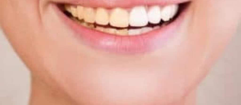home-teeth-whitening