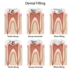 How Much Do Fillings Cost in Australia