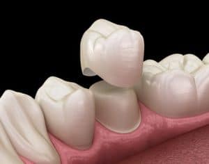 All-Ceramic Dental Crowns
