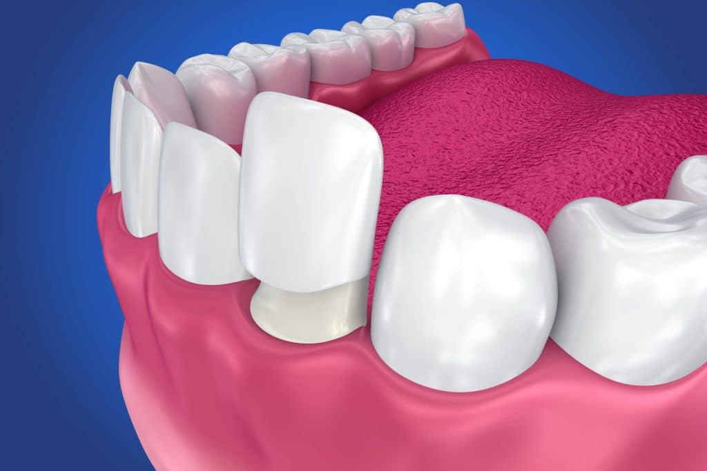 Minimal Tooth Alteration
