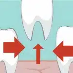 Shifting of Nearby Teeth