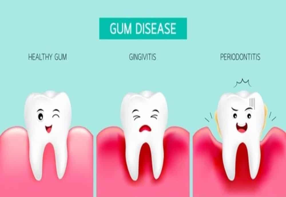 Tooth Decay and Gum Disease
