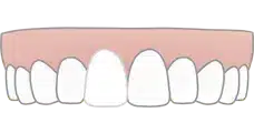 strongly-discoloured-teeth