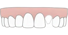 teeth-anomalies-removebg-preview