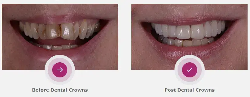 Dental-Crowns-Before-After