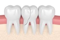 Cracked, chipped or damaged teeth.