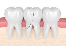 Cracked, chipped or damaged teeth.