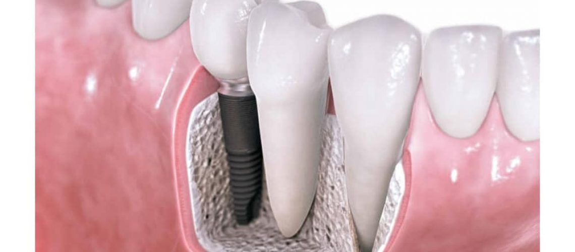 dental-implants-living