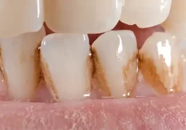 discolored-teeth